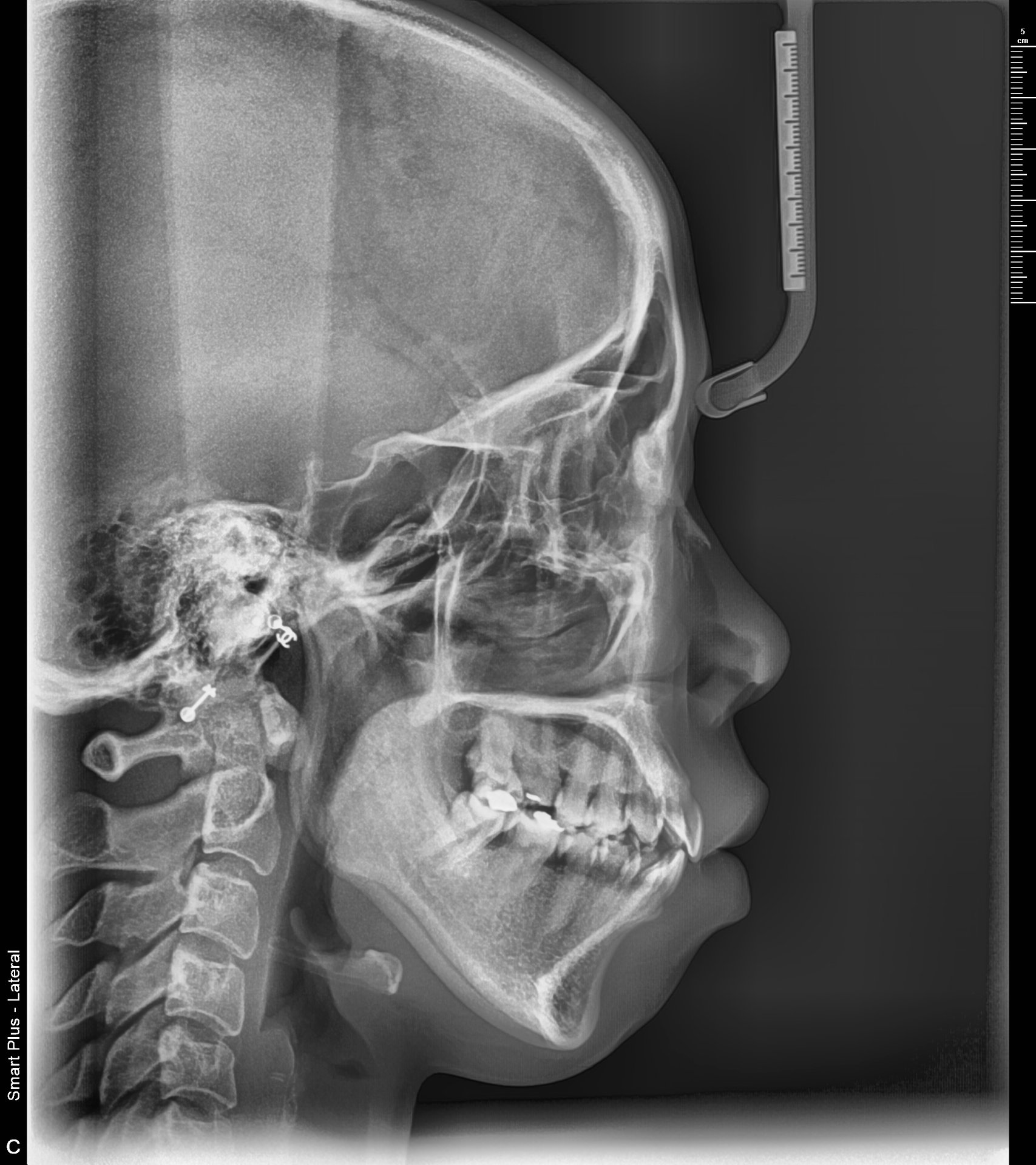 세팔로 X-Ray — 골격·치아 전후관계 분석
